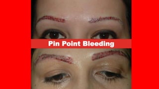 Pin Point Bleeding
 