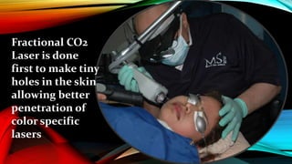 Fractional CO2
Laser is done
first to make tiny
holes in the skin
allowing better
penetration of
color specific
lasers
 