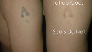 Tattoo Goes
Scars Do Not
 