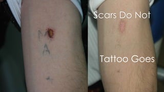 Tattoo Goes
Scars Do Not
 