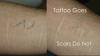 Tattoo Goes
Scars Do Not
 