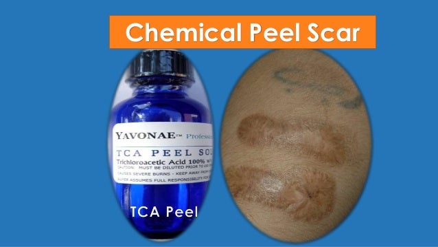 laser tattoo removal 2015 laser tattoo removal 2015