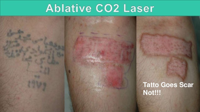 laser tattoo removal 2015 laser tattoo removal 2015