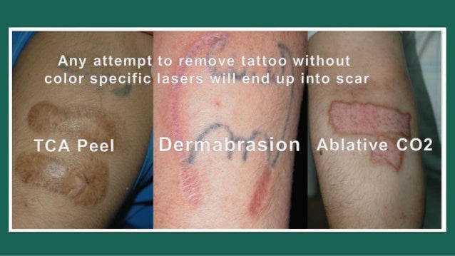 laser tattoo removal 2015 laser tattoo removal 2015