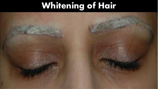 laser tattoo removal 2015 laser tattoo removal 2015