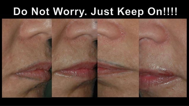 laser tattoo removal 2015 laser tattoo removal 2015
