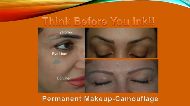laser tattoo removal 2015 laser tattoo removal 2015