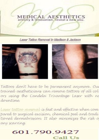 Laser Tattoo Removal In Madison & Jackson 
Tattoos don't have to be permanent anymore. Our 
trained aestheticians can remove tattoos of all col-ors 
using the Candela Trivantage Laser with no 
downtime. 
Laser tattoo removal is fast and effective when com-pared 
to surgical excision, chemical peel and tradi-tional 
dermabrasion. It also minimizes the risk of 
any scarring. 
