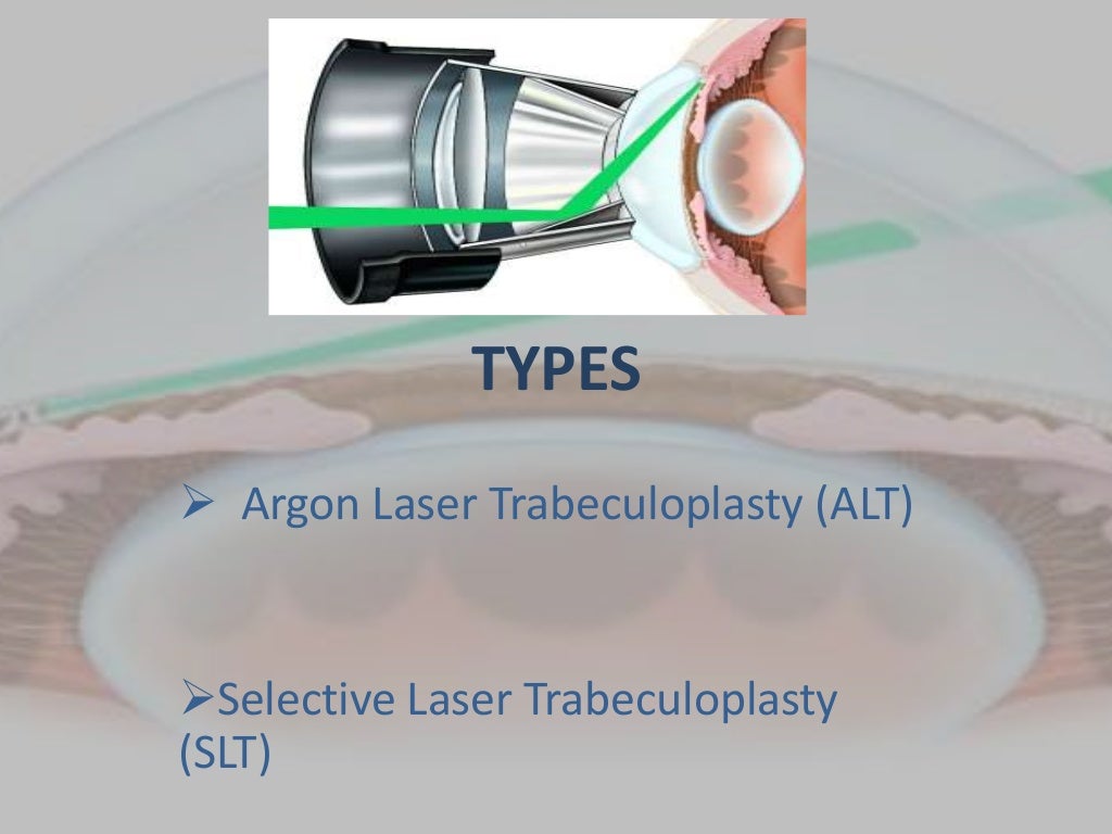 Laser trabeculoplasty