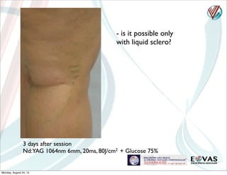 - is it possible only
with liquid sclero?
3 days after session
Nd:YAG 1064nm 6mm, 20ms, 80J/cm2 + Glucose 75%
Monday, August 24, 15
 