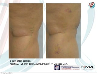- is it possible only
with liquid sclero?
3 days after session
Nd:YAG 1064nm 6mm, 20ms, 80J/cm2 + Glucose 75%
Monday, August 24, 15
 