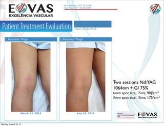  
Two sessions Nd:YAG
1064nm + Gl 75%
6mm spot size, 15ms, 90J/cm2
3mm spot size, 15ms, 175/cm2
Monday, August 24, 15
 