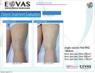 Rua Itapeva, 202 12.andar
Sao Paulo-SP , 01322-000
Patient: Eloiza Rodrigues
Date of Birth: June 8, 1960
Date: 09/09/2014
R Posterior Thigh
July 29, 2014
R Posterior Thigh
Sept. 9, 2014
single session Nd:YAG
1064nm
6mm spot size, 20ms, 70J/cm2
6mm spot size, 15ms, 90J/cm2
3mm spot size, 15ms, 175J/cm2
Monday, August 24, 15
 