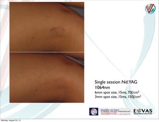 Single session Nd:YAG
1064nm
6mm spot size, 15ms, 70J/cm2
3mm spot size, 15ms, 150J/cm2
Monday, August 24, 15
 