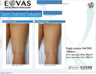 3760 South Lindbergh Blvd Suite 101
St. Louis , Missouri 63127
(314) 849-0923
Patient: Tositto Valquiria
Date of Birth: Jan. 1, 1995
Date: 11/29/2014
R Posterior Thigh
Nov. 29, 2014
R Posterior Thigh
Nov. 29, 2014
Single session Nd:YAG
1064nm
6mm spot size, 20ms, 80J/cm2
6mm spot size, 15ms, 90J/cm2
Monday, August 24, 15
 