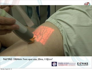 Nd:YAG 1064nm 7mm spot size, 20ms, 110J/cm2
Monday, August 24, 15
 