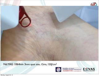 Nd:YAG 1064nm 3mm spot size, 15ms, 150J/cm2
Monday, August 24, 15
 