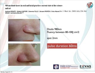 Int. J. Med. Sci. 2009; 6(6):358-364
Diodo 980nm
Fluency between 80-100J cm/2
spot 2mm
pulse duration 60ms
Monday, August 24, 15
 