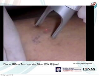 Diodo 980nm 2mm spot size, 70ms, 60W, 105J/cm2 Dr. Fadul J, Quito-Equador
Monday, August 24, 15
 