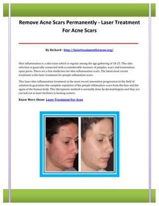 Remove Acne Scars Permanently - Laser Treatment 
For Acne Scars 
__________________________________________ 
By Richard - http://lasertreatmentforacne.org/ 
Skin inflammation is a skin issue which is regular among the age gathering of 18-25. This skin 
infection is generally connected with a considerable measure of pimples, scars and tremendous 
open pores. There are a few medicines for skin inflammation scars. The latest most recent 
treatment is the laser treatment for pimple inflamation scars. 
This laser skin inflammation treatment is the most recent innovation progression in the field of 
solution to guarantee the complete expulsion of the pimple inflamation scars from the face and the 
again of the human body. This therapeutic method is normally done by dermatologists and they are 
carried out in laser facilities in healing centers. 
Know More About Laser Treatment For Acne 
 