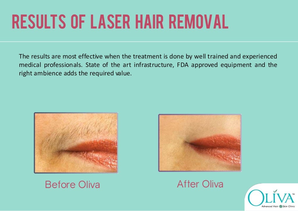 Laser Hair Removal Treatment in Hyderabad