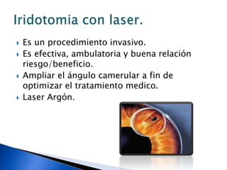 Técnica.Lente 3 espejos o lente de Ritch.Parámetros.Spot 50.2 técnicas.Clasica:1000mW y 0.1 seg.700mW y 0.2 seg.Ubicación.En el trabeculado anterior.Imagen a obtener.Una burbuja pequeña instantánea o un blanqueo en el área pigmentada.Espacios interdisparos.Iguales de forma tal que entre uno y otro spot haya unos 50.Trabeculoplastia.