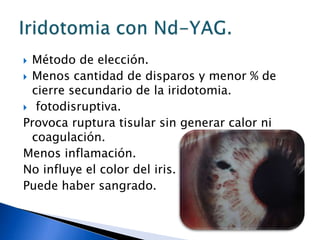 Se basa en el uso de pulsos cortos de energía laser de baja intensidad que actúan sobre células trabeculares que contienen melanina.Esto produce fototermolisis de los gránulos de melanina sin producción de coagulación ni cicatriz tisular y aumenta el numero de macrófagos que limpian dicho pigmento trabecular, facilita la salida acuosa.Trabeculoplastia selectiva.
