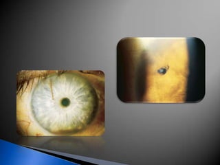 Longitud de onda es de 532nm.