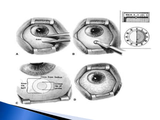 Método de elección.Menos cantidad de disparos y menor % de cierre secundario de la iridotomia. fotodisruptiva.Provoca ruptura tisular sin generar calor ni coagulación.Menos inflamación.No influye el color del iris.Puede haber sangrado.Iridotomia con Nd-YAG.