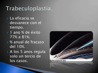 Iridotomia con laser.