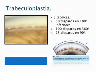 Cirugía ciclodestructiva del glaucoma.Procedimientos.