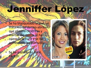 Jenniffer López Se ha blanqueado la piel, un tratamiento dermo-abrasivo que elimina cicatrices y marcas del rostro se ha operado la nariz y se ha aumentado los pómulos. Se ha gastado en total 14.300. 