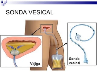 SONDA VESICAL
 