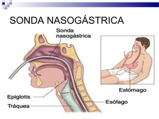 SONDA NASOGÁSTRICA
 