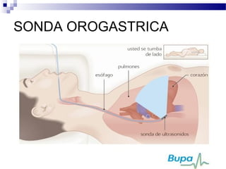 SONDA OROGASTRICA
 