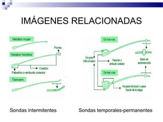 IMÁGENES RELACIONADAS
Sondas intermitentes Sondas temporales-permanentes
 