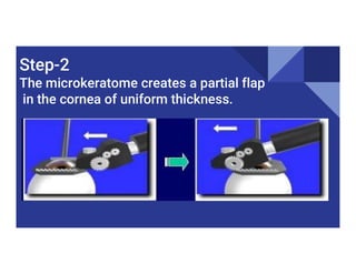 Step-2
The microkeratome creates a partial flap
in the cornea of uniform thickness.
 