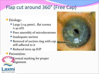 Flap cut around 360° (Free Cap)
Etiology-
Large (>14.5mm) , flat cornea
(<41.0D)
Poor assembly of microkeratome
Inadequate suction
Removal of suction ring with cap
still adhered to it
Reduced intra op IOP
Prevention:
Corneal marking for proper
alignment
 