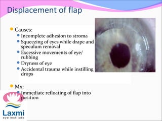 Displacement of flap
Causes:
Incomplete adhesion to stroma
Squeezing of eyes while drape and
speculum removal
Excessive movements of eye/
rubbing
Dryness of eye
Accidental trauma while instilling
drops
Mx:
Immediate refloating of flap into
position
 