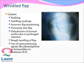 Wrinkled flap
Causes:
Rubbing
Instilling eyedrops
Incorrect flap positioning
Extremely thin flap
Dehydration of stromal
surface due to prolonged
exposure
Rough handling of flap
Use of vasoconstricting
agents like phenylephrine
or brimonidine to
minimize SCH
 