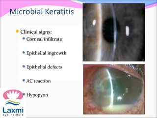 Clinical signs:
Corneal infiltrate
Epithelial ingrowth
Epithelial defects
AC reaction
Hypopyon
Microbial Keratitis
 
