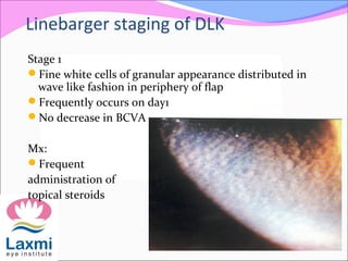Linebarger staging of DLK
Stage 1
Fine white cells of granular appearance distributed in
wave like fashion in periphery of flap
Frequently occurs on day1
No decrease in BCVA
Mx:
Frequent
administration of
topical steroids
 