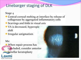 Stage 4
Central corneal melting at interface by release of
collagenase by aggregated inflammatory cells
Scarrings and folds in visual axis
VA is decreased, hyperopic
shift
Irregular astigmatism
Mx:
When repair process has
concluded, consider anterior
lamellar keratoplasty
Linebarger staging of DLK
 