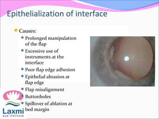 Epithelialization of interface
Causes:
Prolonged manipulation
of the flap
Excessive use of
instruments at the
interface
Poor flap edge adhesion
Epithelial abrasion at
flap edge
Flap misalignment
Buttonholes
Spillover of ablation at
bed margin
 