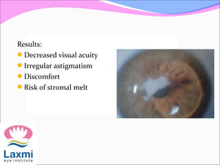 Results:
Decreased visual acuity
Irregular astigmatism
Discomfort
Risk of stromal melt
 