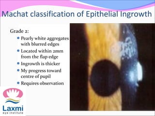 Grade 2:
Pearly white aggregates
with blurred edges
Located within 2mm
from the flap edge
Ingrowth is thicker
My progress toward
centre of pupil
Requires observation
Machat classification of Epithelial Ingrowth
 