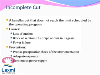 Incomplete Cut
A lamellar cut that does not reach the limit scheduled by
the operating program
Causes:
Loss of suction
Block of keratome by drape or dust in its gears
Power failure
Prevention:
Precise preoperative check of the instrumentation
Adequate exposure
Continuous power supply
 