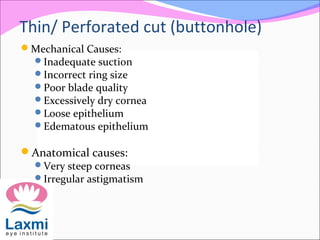 Thin/ Perforated cut (buttonhole)
Mechanical Causes:
Inadequate suction
Incorrect ring size
Poor blade quality
Excessively dry cornea
Loose epithelium
Edematous epithelium
Anatomical causes:
Very steep corneas
Irregular astigmatism
 