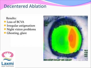 Results:
Loss of BCVA
Irregular astigmatism
Night vision problems
Ghosting, glare
Decentered Ablation
 