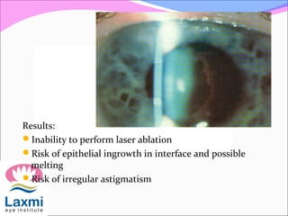 Results:
Inability to perform laser ablation
Risk of epithelial ingrowth in interface and possible
melting
Risk of irregular astigmatism
 